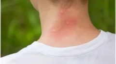 Nástroje z svědění: jak ochoďte kousnutí proti komárům